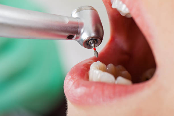 Best Emergency Dental Extractions in Vcennes, IN